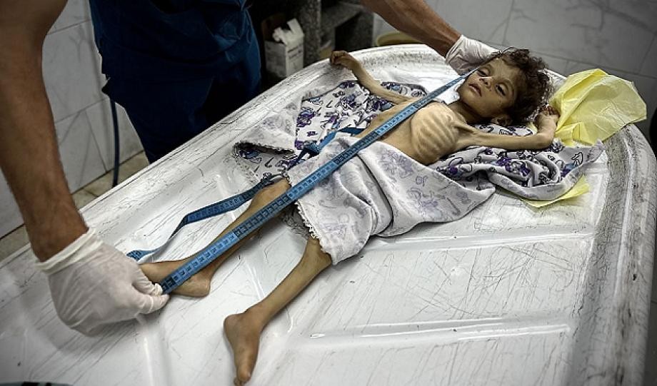 غزة تشهد 11 حالة وفاة جديدة جراء الجوع خلال 24 ساعة